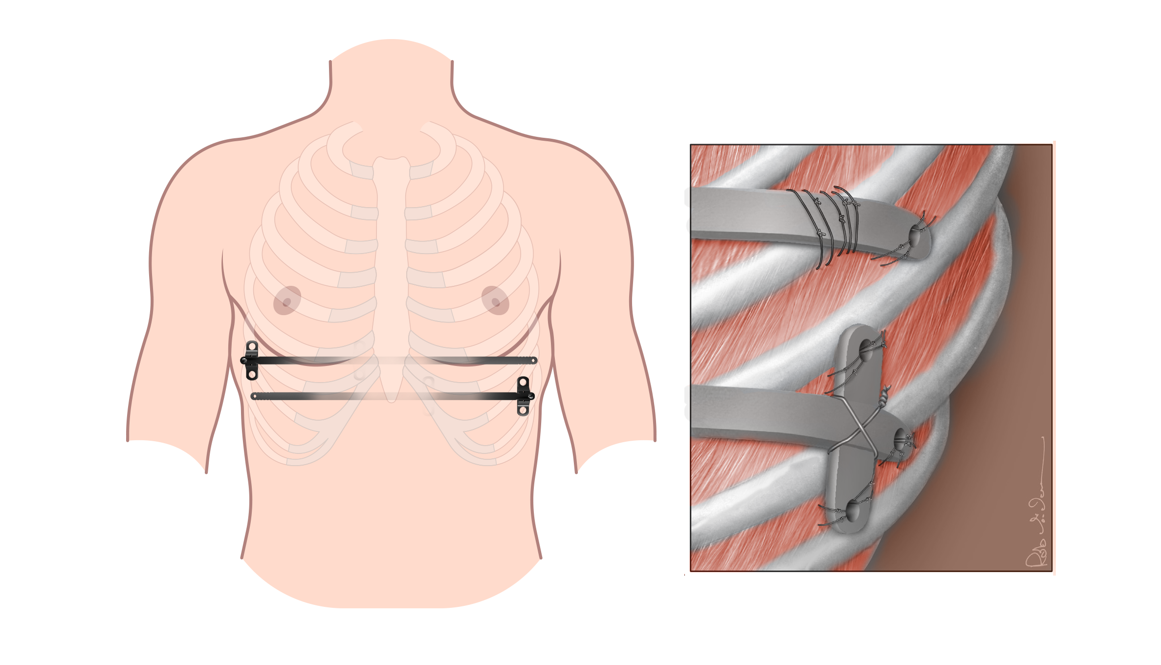 Illustratie van een romp met twee metalen staven op de ribben, inzet toont bevestiging aan de ribben voor pectus excavatum correctie.