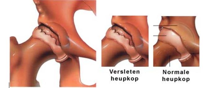 Medische illustratie: links een versleten heupkop, rechts een normale heupkop met glad oppervlak.