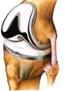 Illustratie van een kniegewricht met metalen knieprothese, zichtbaar op boven- en onderbeen, uitgelijnd met bot en weefsel.