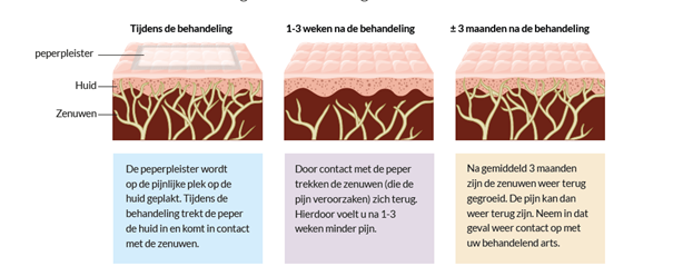 Diagram met 3 panelen over Qutenza-pleister: effect op huid/zenuwen tijdens, na 1-3 weken, en na 3 maanden.