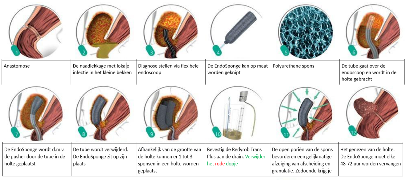 Stap-voor-stap illustratie van Endo-Sponge behandeling bij een anastomotisch lek in de dikke darm.