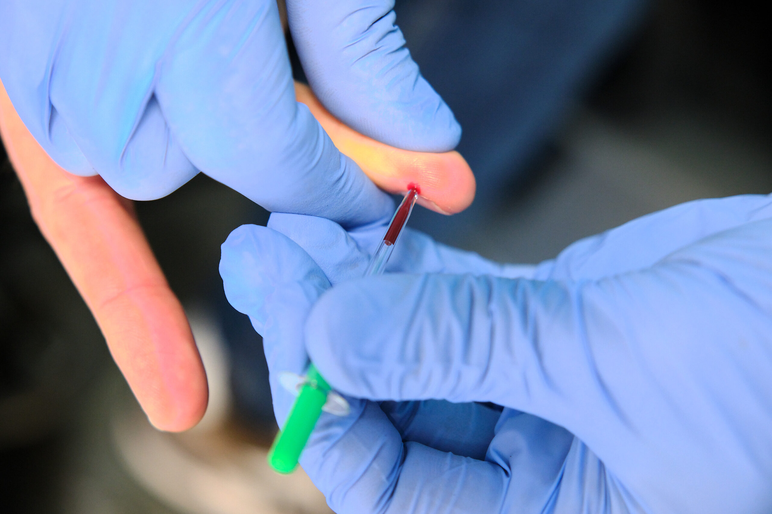 Iemand met blauwe handschoenen neemt bloed af uit een vinger met een buisje tijdens een sneltest bij hartinfarcten.