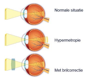 Drie oogdiagrammen: normaal zicht, bijziendheid met focus vóór het netvlies, en correctie met bril.