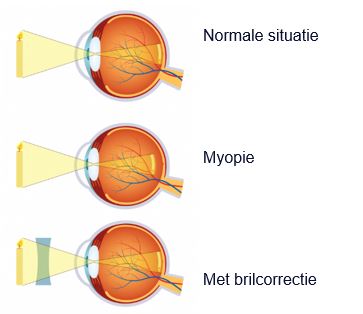 Drie oogdiagrammen: normaal zicht, bijziendheid met focus voor het netvlies, en correctie met bril.