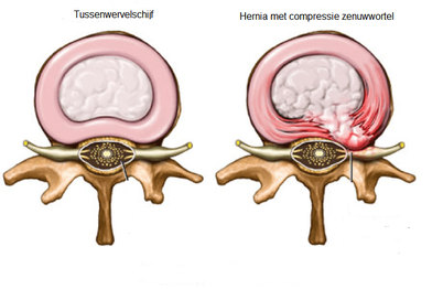 Twee medische illustraties: links een normale tussenwervelschijf, rechts een hernia met zenuwbeknelling (rood).