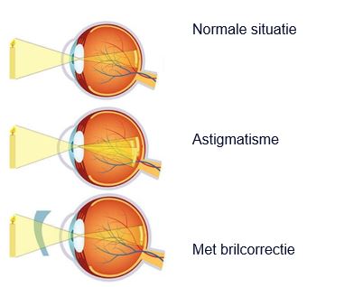 Drie oogdiagrammen: normaal zicht, onscherp door bijziendheid en gecorrigeerd zicht met bril.