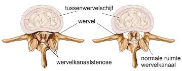 Twee doorsneden van de wervelkolom: links lumbale stenose, rechts een normaal open wervelkanaal.