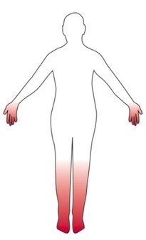 Omtrek van mensfiguur met rood gemarkeerde handen en onderbenen, ter illustratie van polyneuropathie.