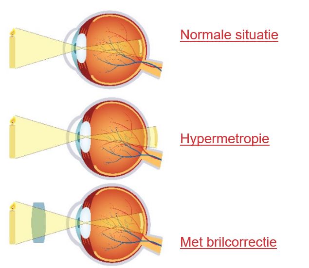 Diagram van drie oogdoorsneden: normaal zicht, hypermetropie en correctie met bril; lichtfocus verschilt.