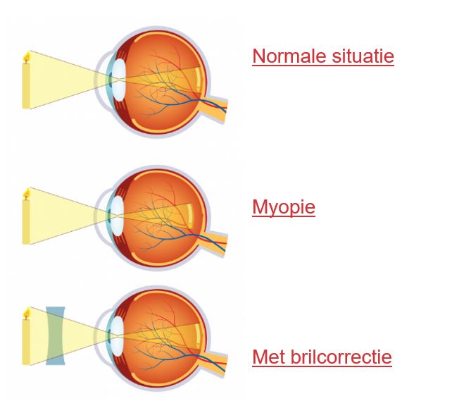 Diagram met drie oogdoorsneden: normaal zicht, bijziendheid en correctie van bijziendheid met bril.
