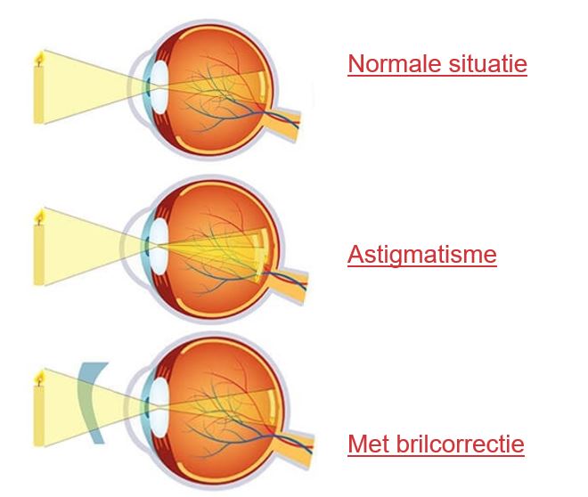Diagram met drie oogdoorsneden: normaal zicht, astigmatisme met verstrooid licht, bril corrigeert astigmatisme.
